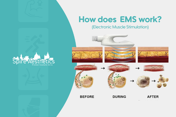 EMS treatment for post pregnancy weight loss treatment City of London