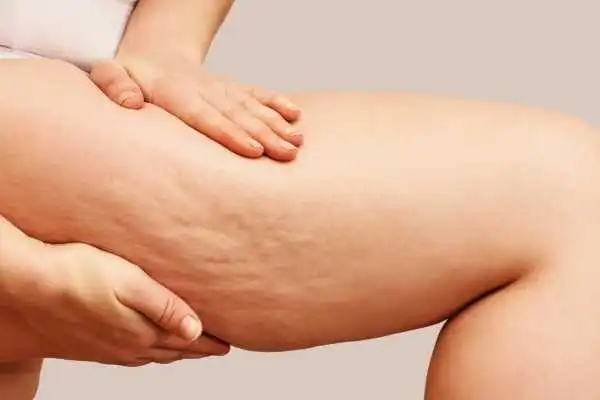Image of woman showing leg with cellulite City of London
