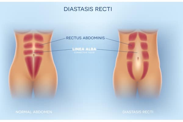 What Non-Surgical Options Are Available for Diastasis Recti City of London?