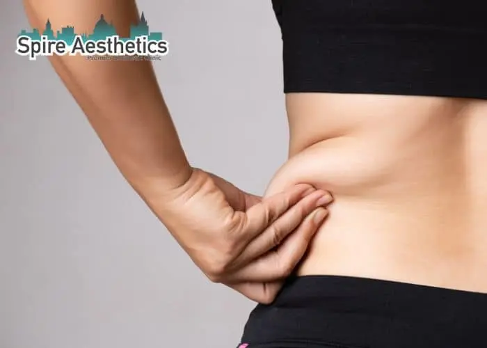 Image of woman pinching fat on their hips City of London. Fat Freezing treatment