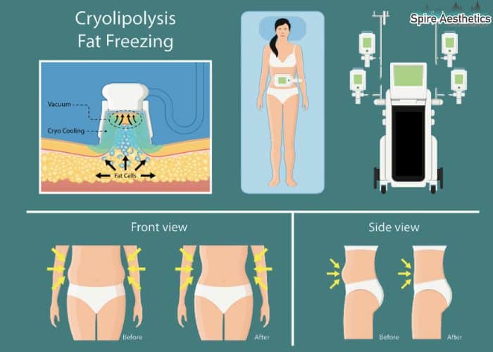 Image of diet and fat freezing combined for best results for Spire Aesthetics City of London