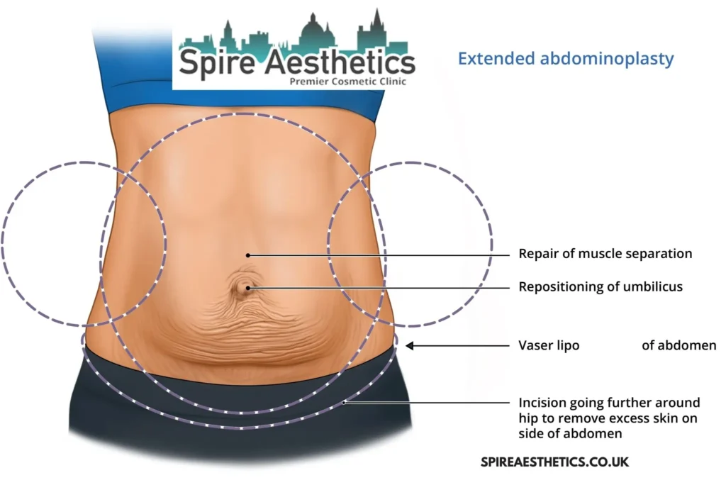Understanding Loose Skin After Gastric Band City of London Surgery and HIFU Treatment