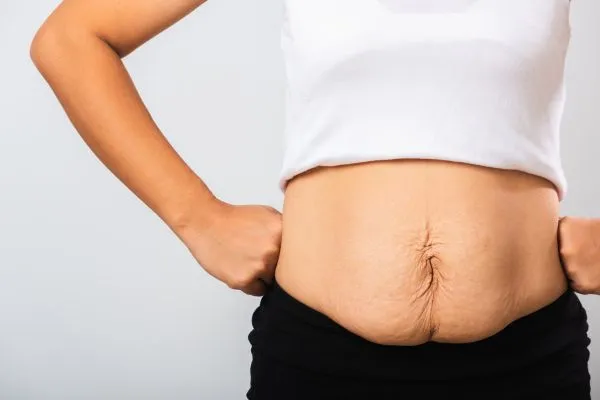 Image of a woman's stomach after weight loss with sagging skin following a gastric band City of London