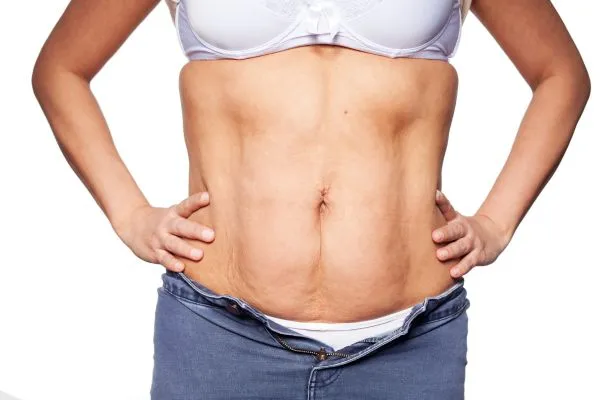 sagging skin on woman's stomach after weight loss injections City of London