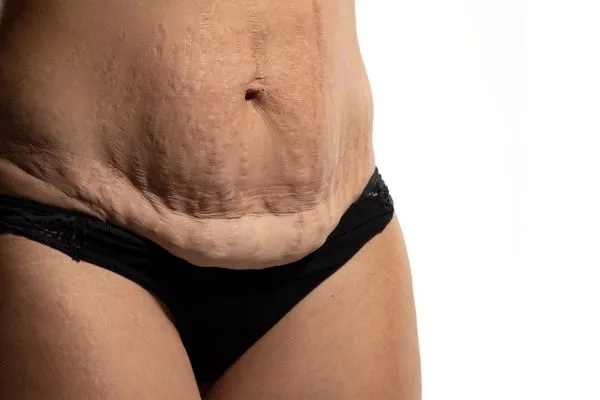 Image of womans stomach after weight loss injections City of London showing saggy skin