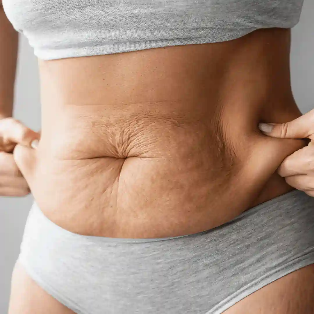 Is It Normal to Have Loose Skin After Pregnancy City of London?