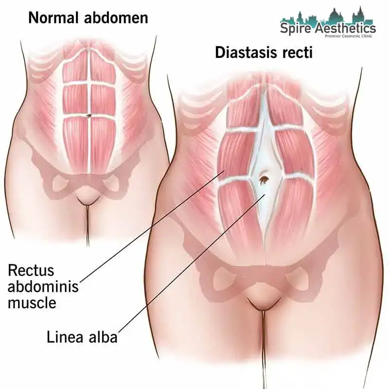 When Will My Belly Feel Normal Again City of London?