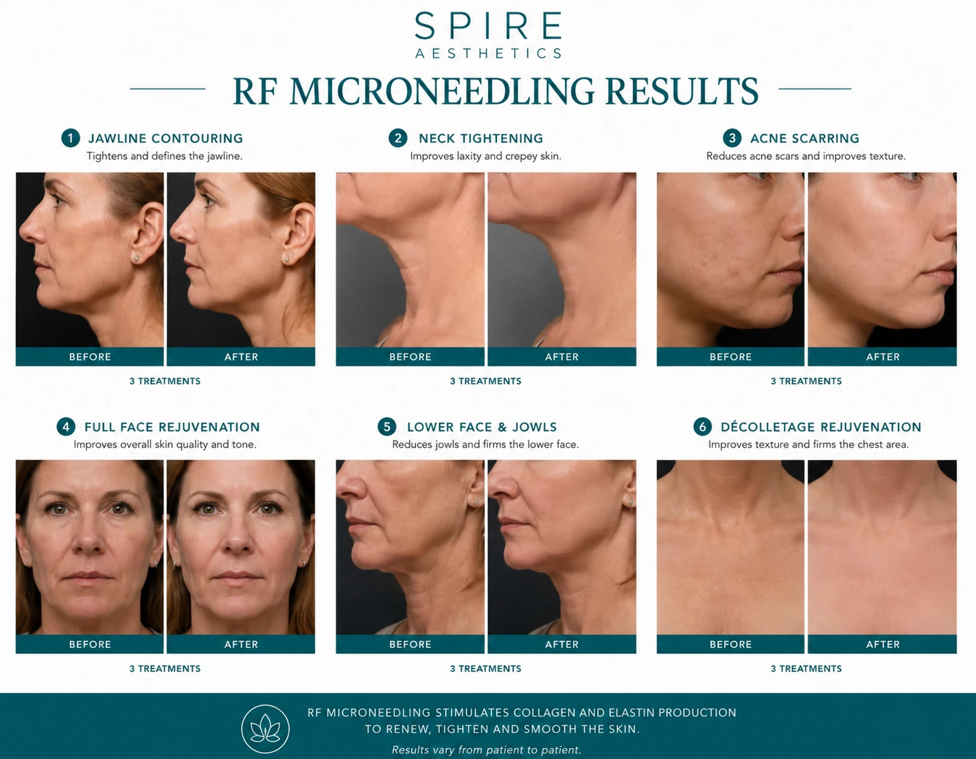 RF Microneedling Skin tightening City of London results