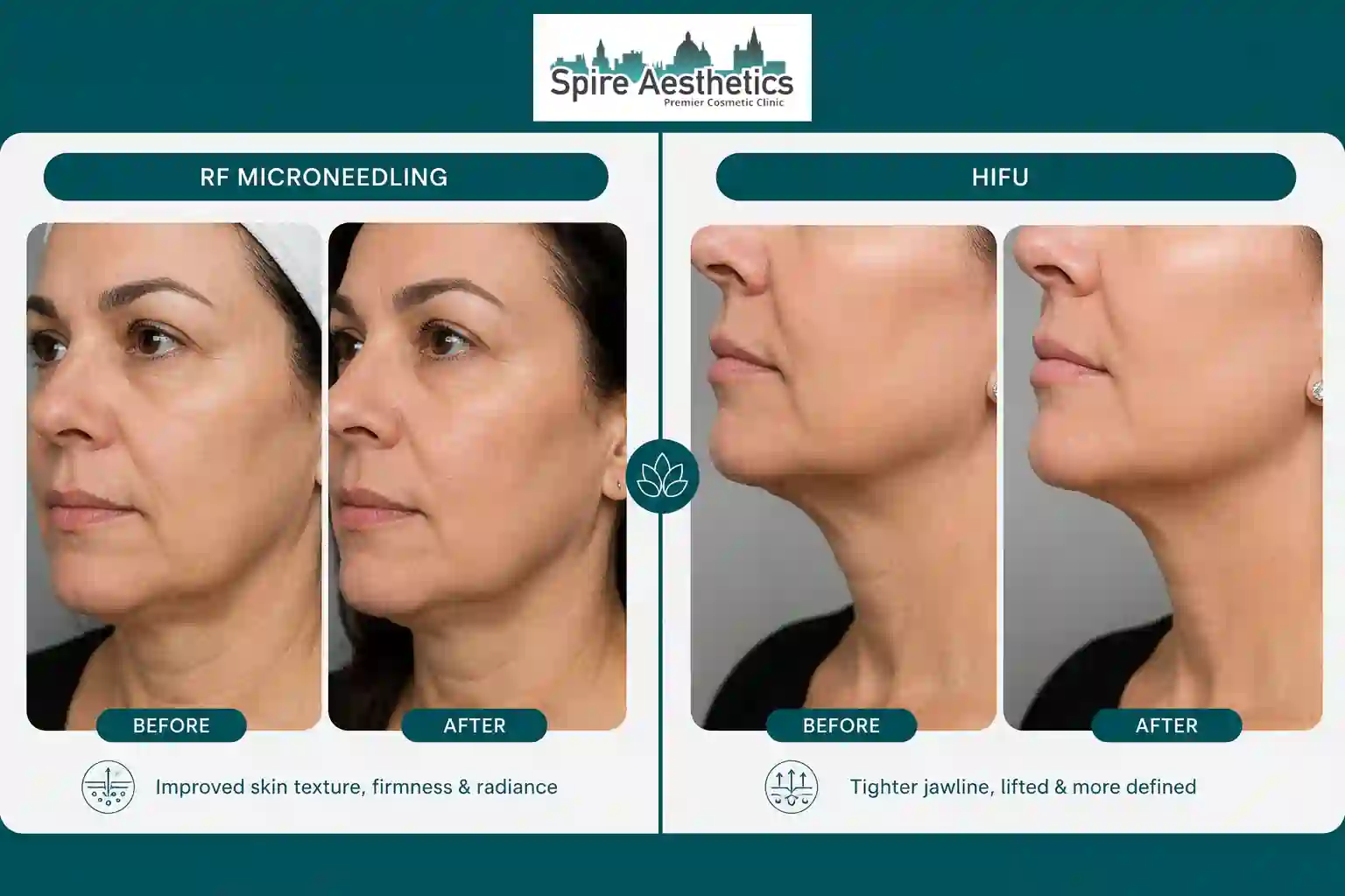 Can RF Microneedling and HIFU Be Combined City of London?