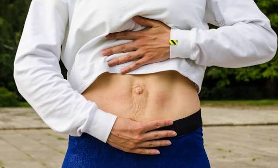 When Could Diastasis Recti Be the Missing Piece of the Puzzle City of London?