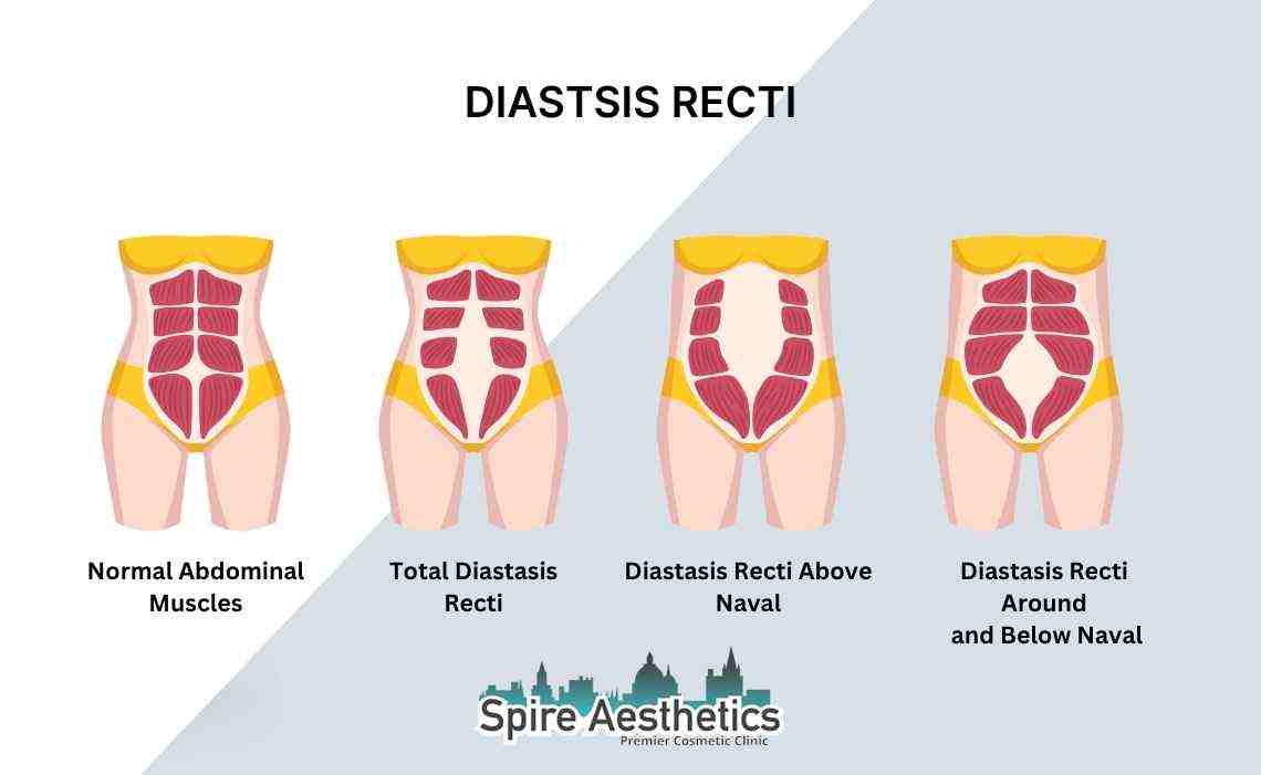 Is Non-Surgical Diastasis Recti Treatment Right for You? Common Concerns Answered City of London